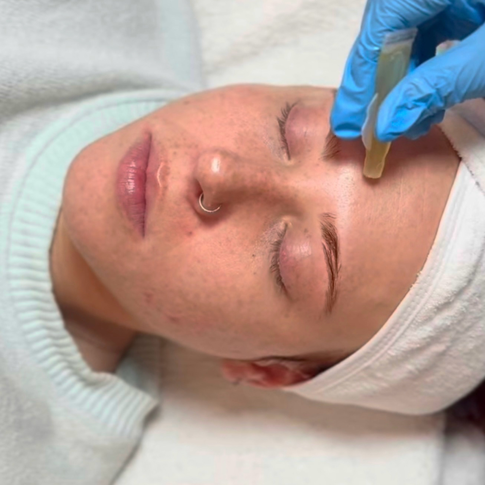 Skin Renewal at Halo Beauty in Toms River, NJ