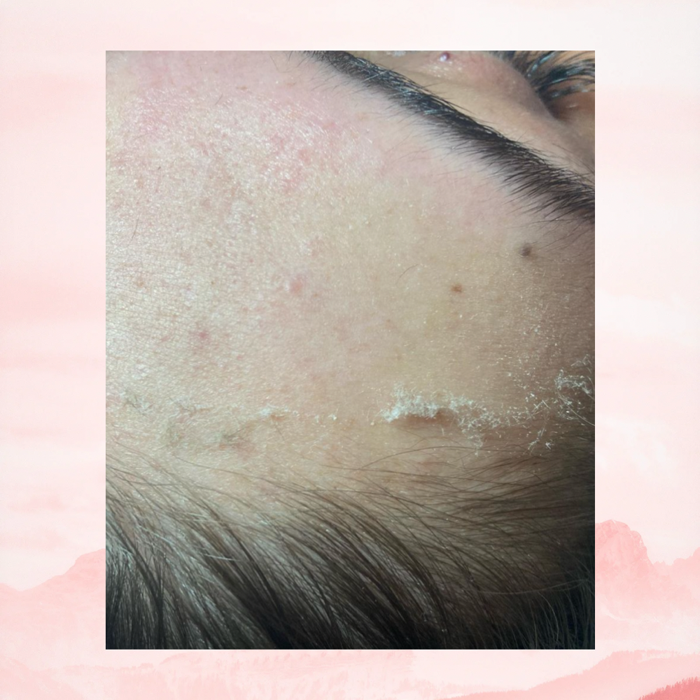 Dermaplane Service