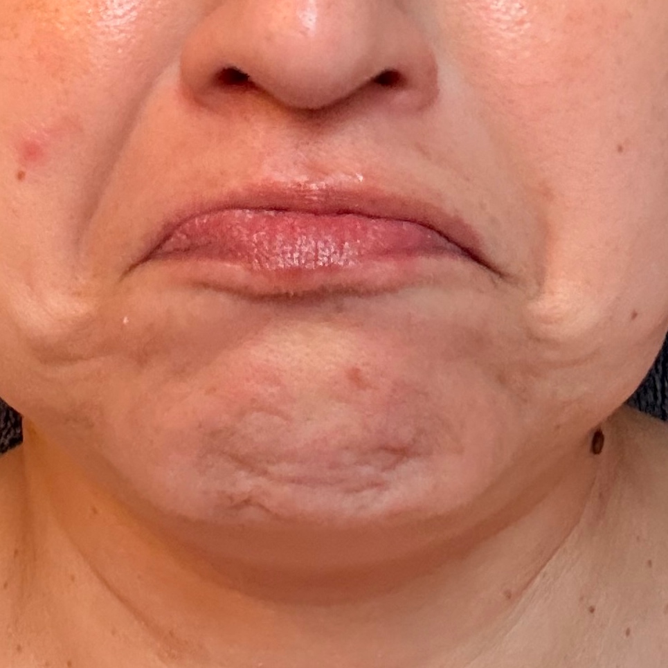 Mentalis at Radiant Aesthetics by Liz in El Paso, TX