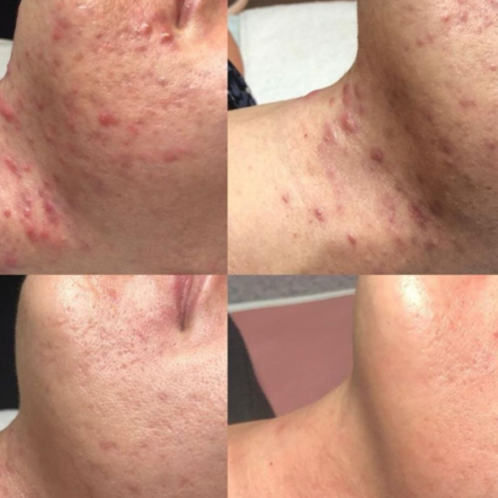 Acne Facial