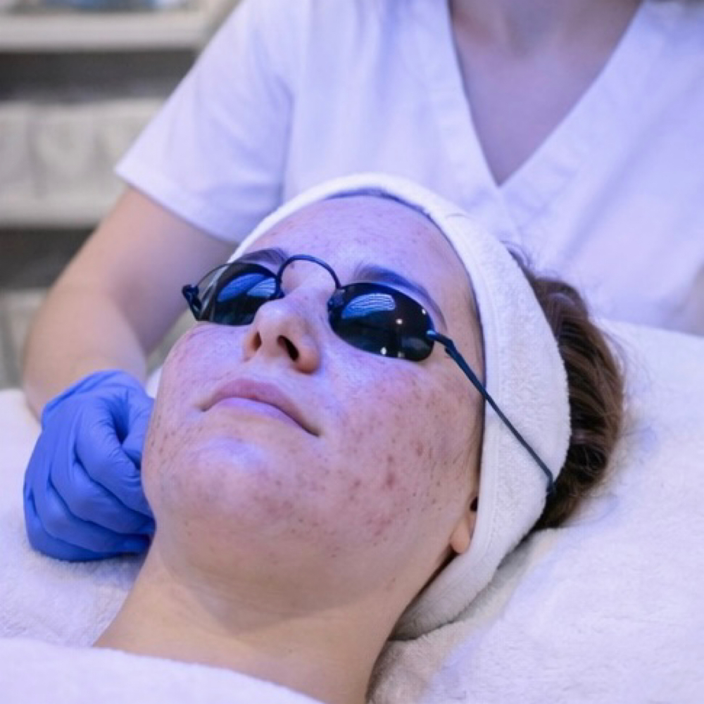 Bi-weekly Acne Treatment