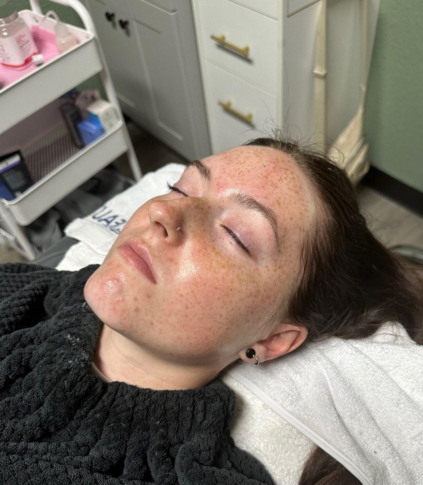 Acne Facial