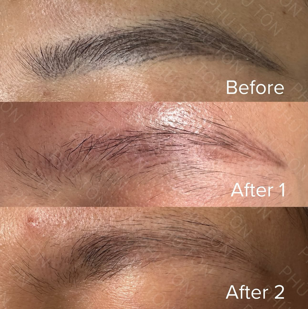 Permanent Eyebrow Removal