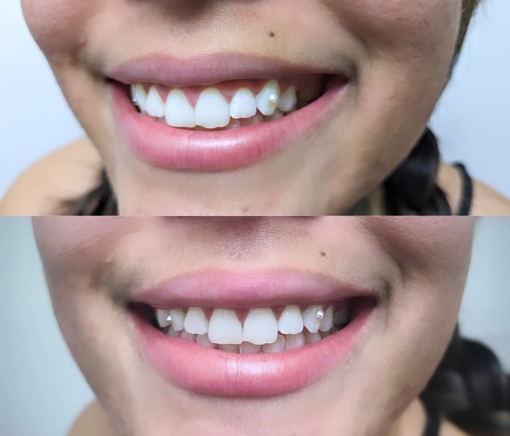 Professional Teeth Whitening