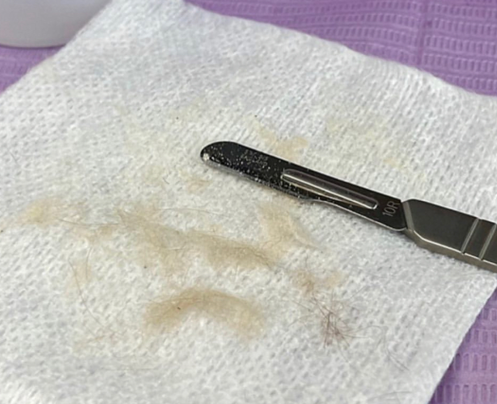 Dermaplaning (Only)