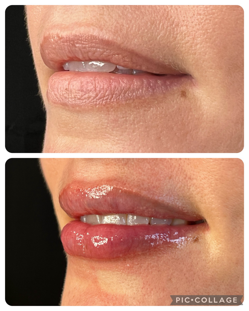 Signature Lip Enhancement