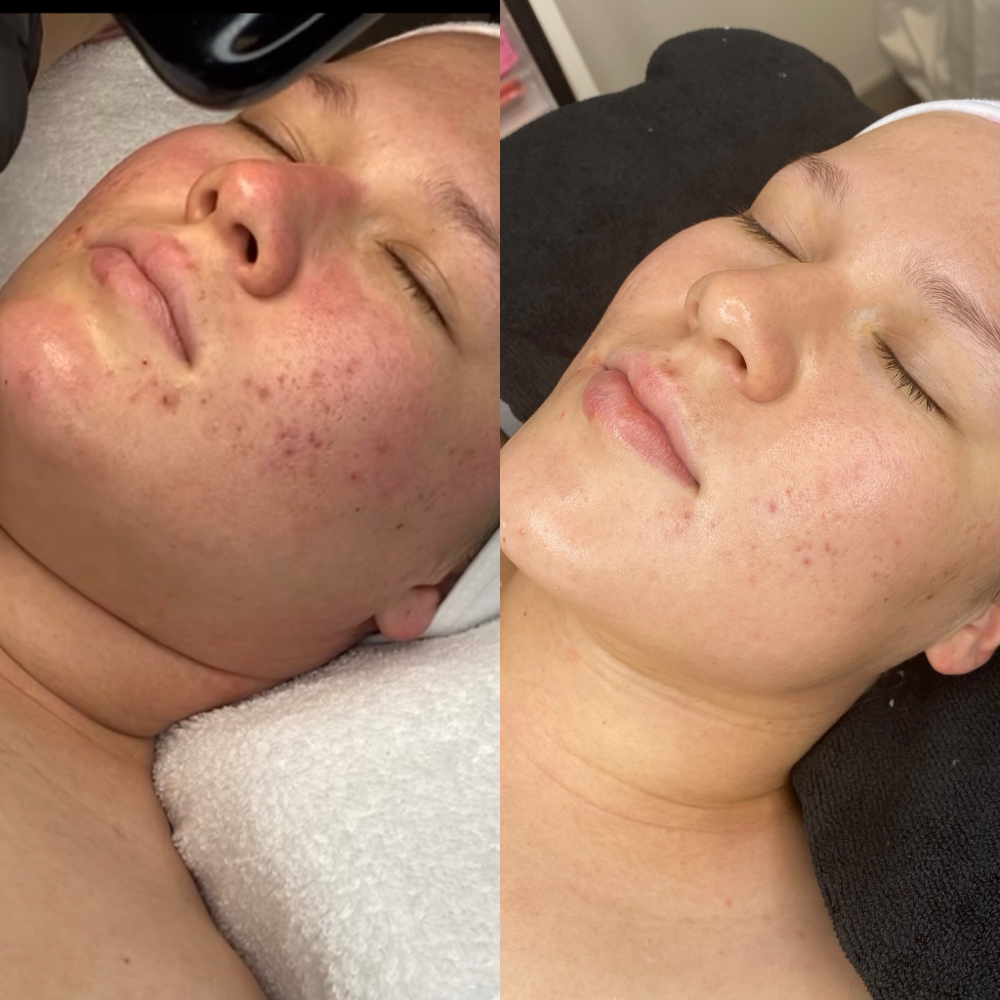 Acne Facial