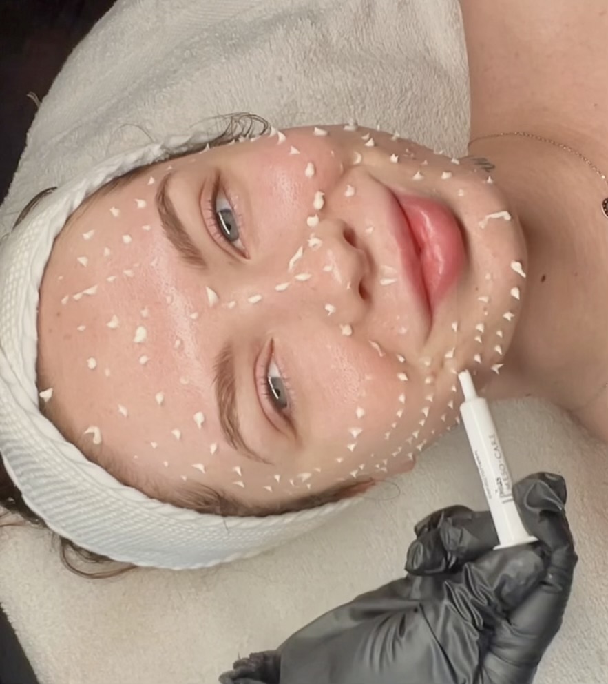 Liquid Microneedling Treatment