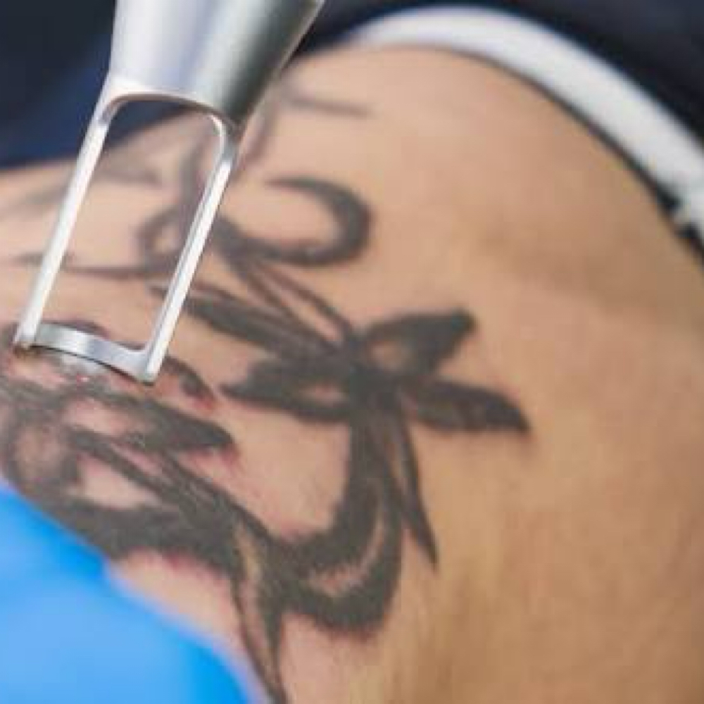 ✨Laser Tattoo Removal(1inch Or Less at Nena’s Beauty Glow Bar in North Las Vegas, NV