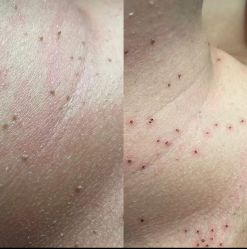 Remocion Verrugas (warts) at LASHES AND BROWS By Karla Escorza in Northglenn, CO