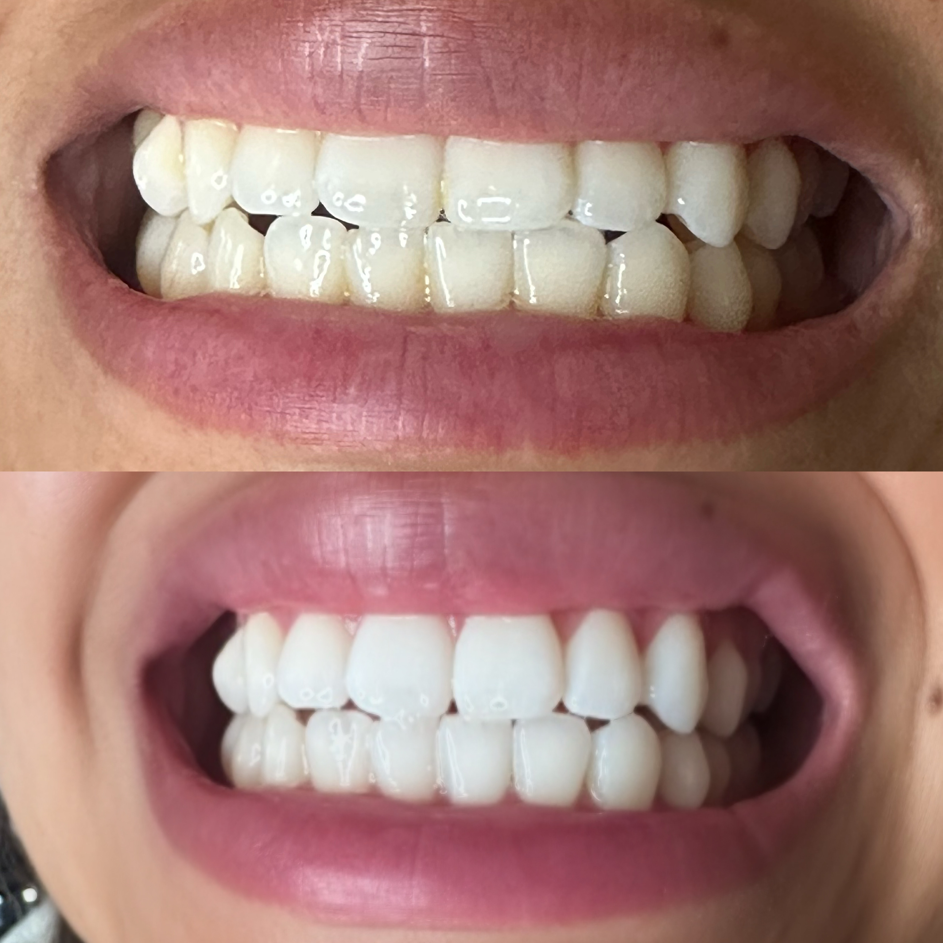 Teeth Whitening