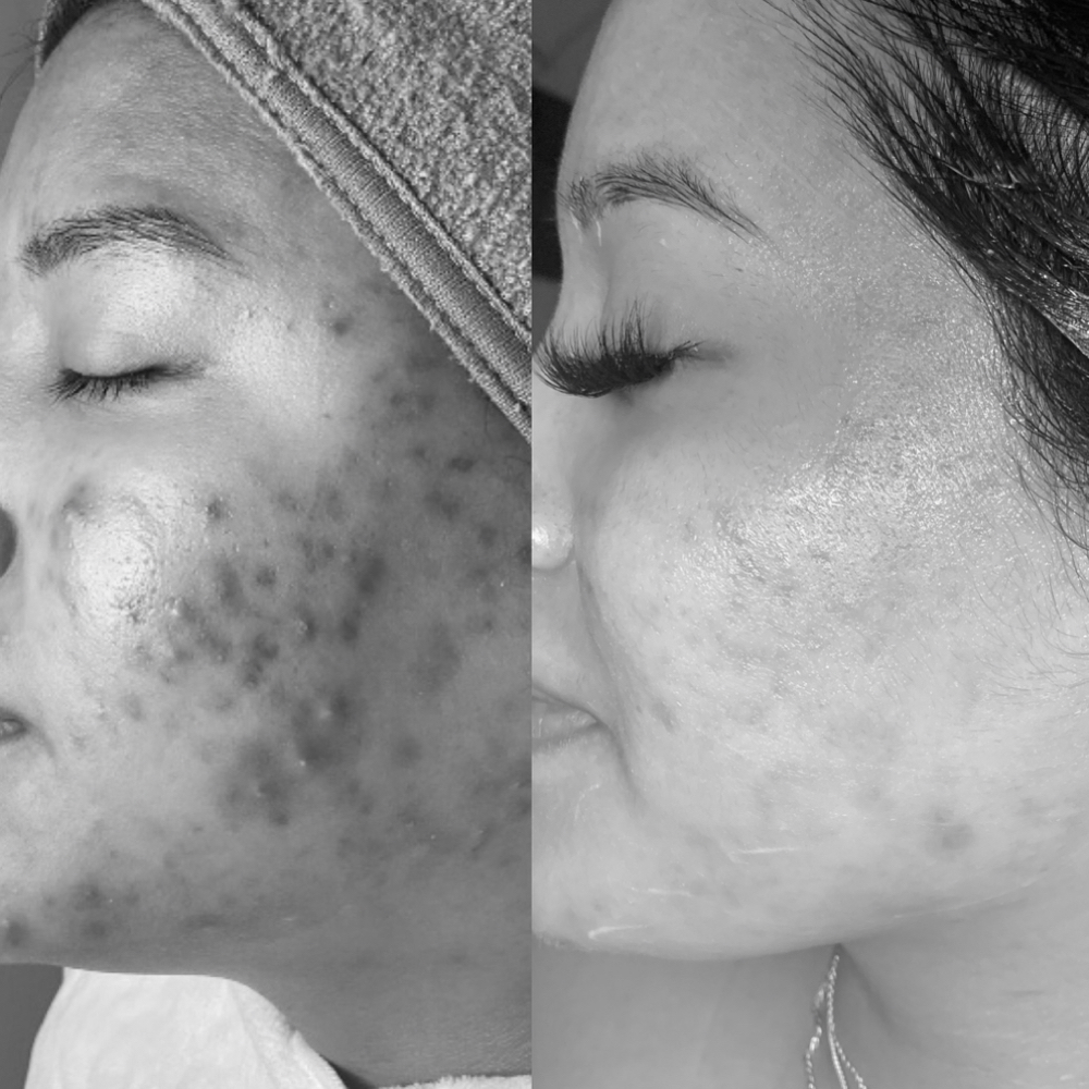 Ance Peel at MySkin Aesthetics in Laredo, TX