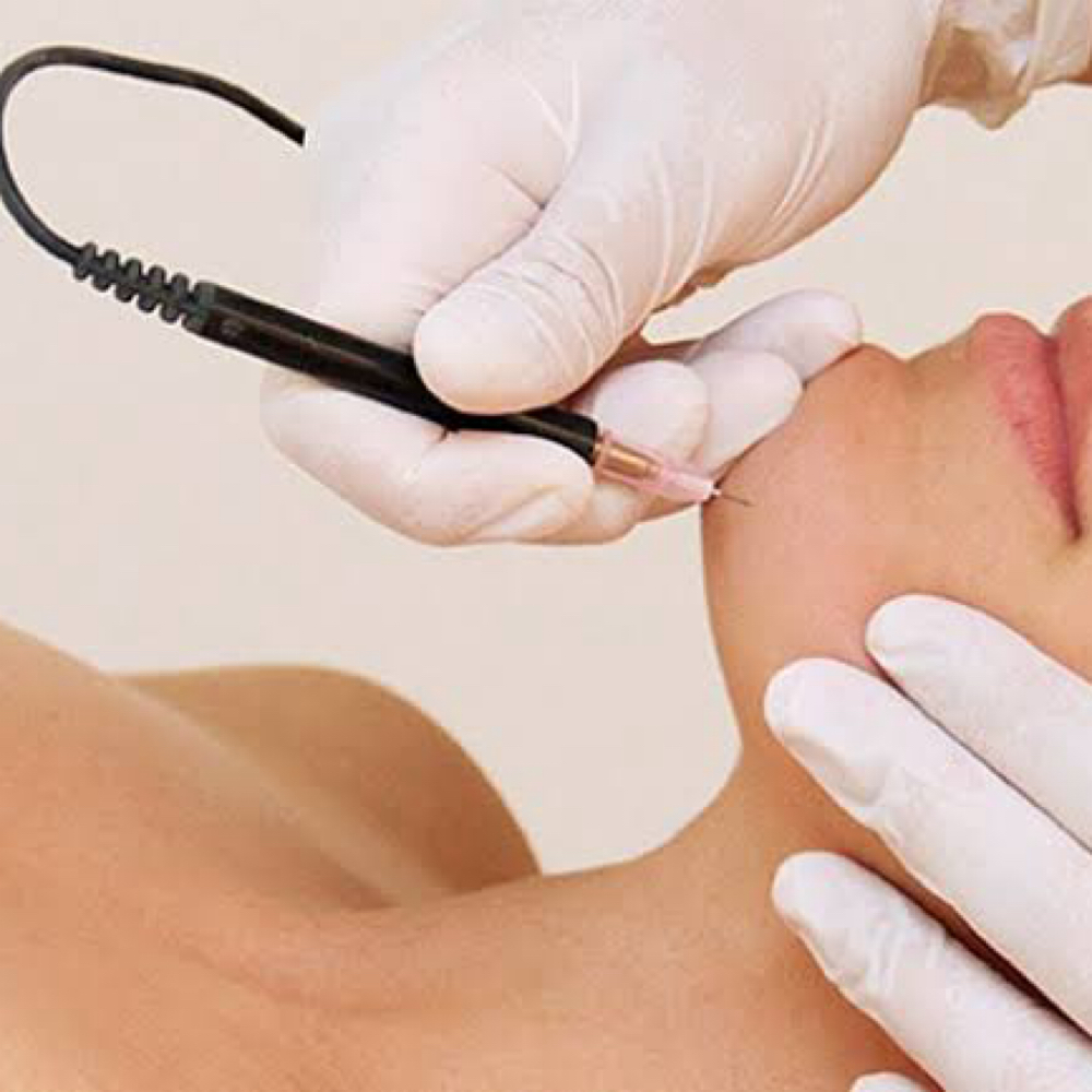 Electrolysis 45 Min Session at Eve Milan New York in White Plains, NY