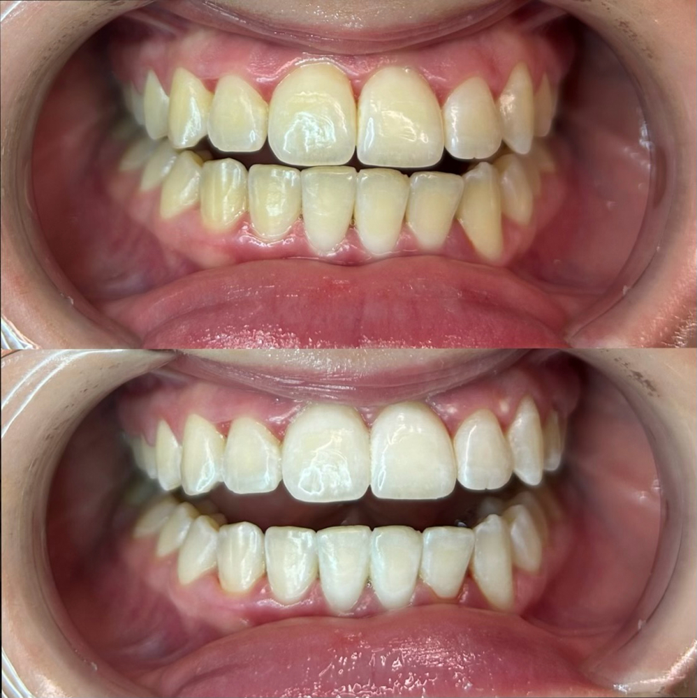 Teeth Whitening Refresher