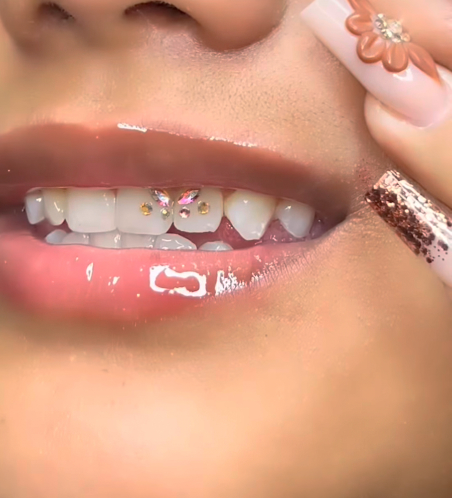 Butterfly Set + 2 Gems at Luxe Glow Smiles in orlando, FL