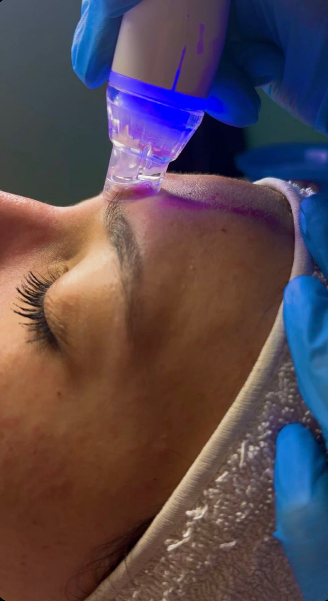 Thrive Hydrofacial + Dermaplain