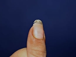 Nail Repair