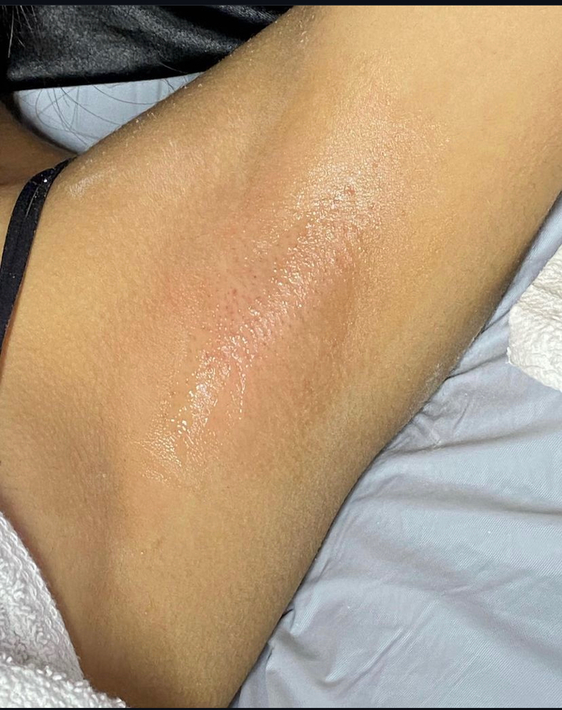 Underarms