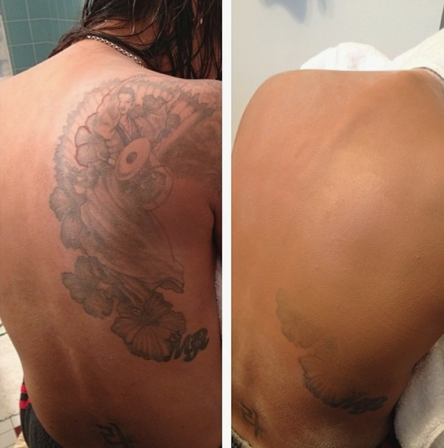 Tatoo Covering (Pricing Varies)