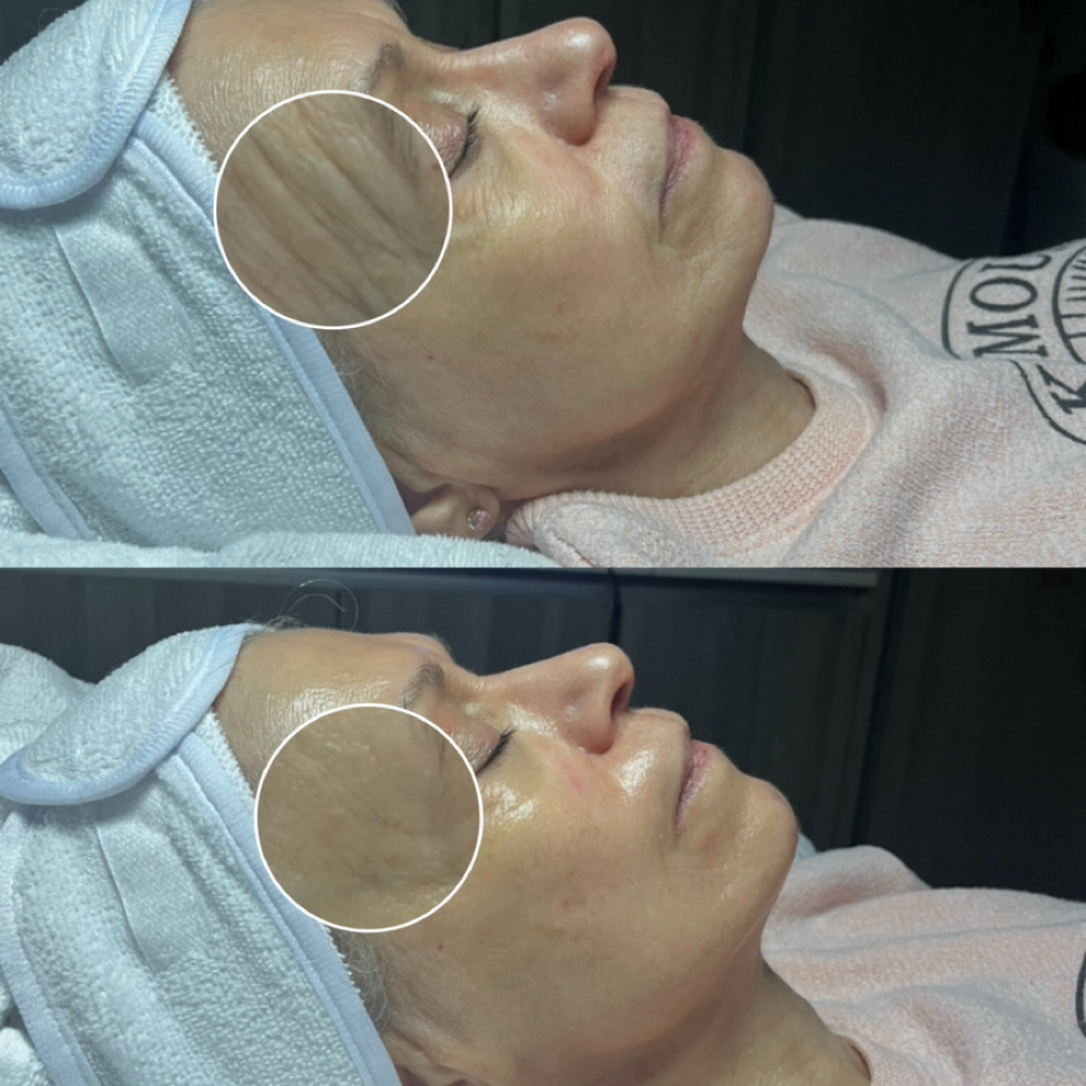 Anti-Aging Facial at Bare Face Beauty LLC in Greenwood, IN