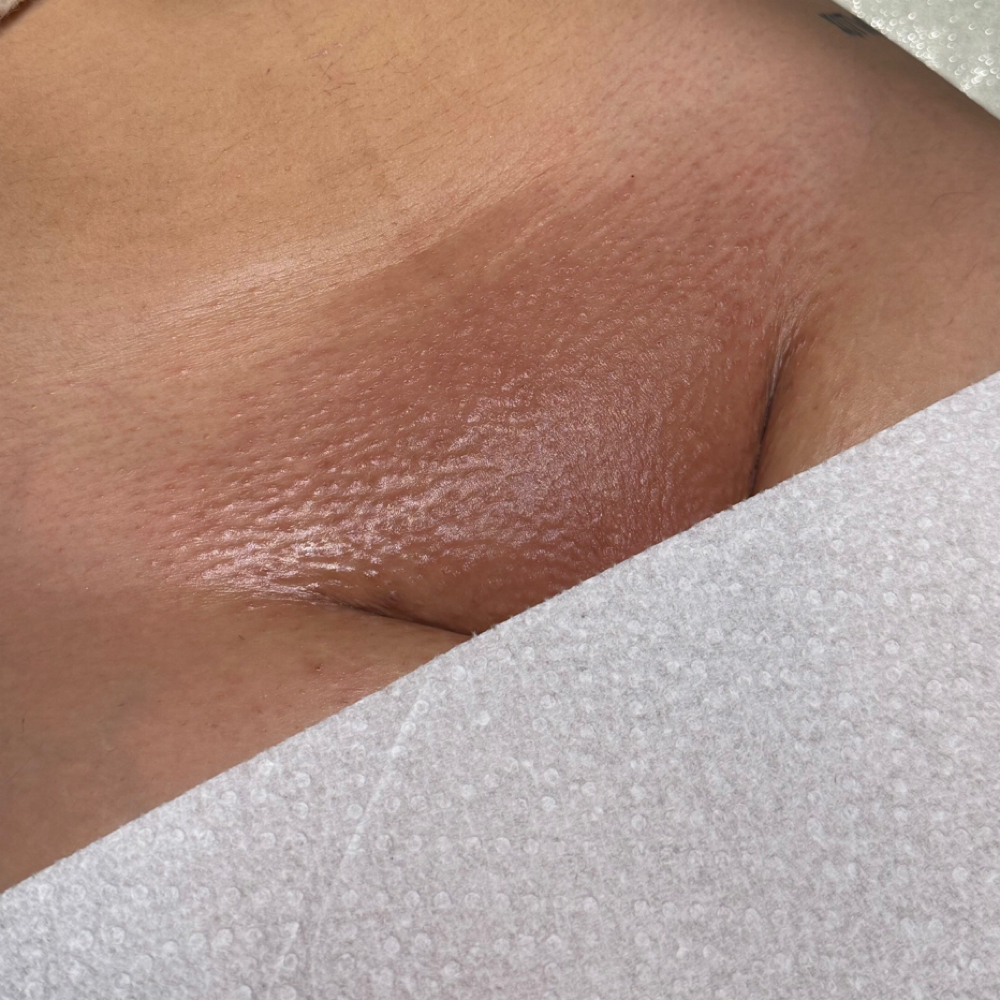 New Client Brazilian Or 6+ weeks at Skinly Beauty in Bakersfield, CA