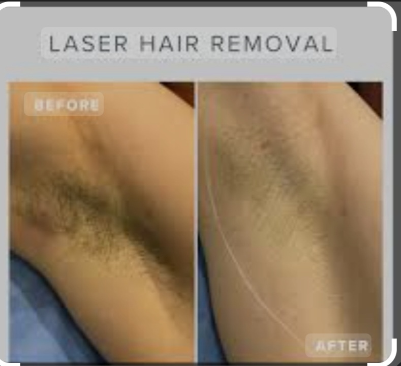 Laser Hair Removal