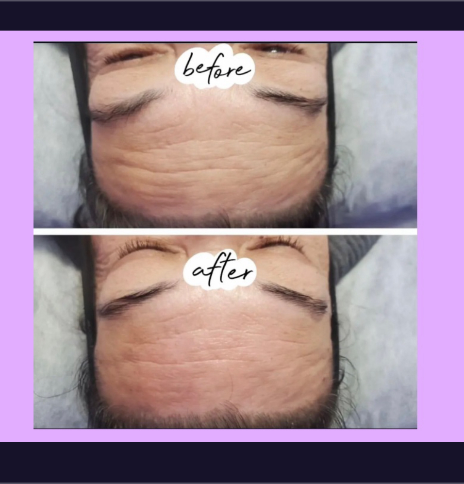 Non-Invasive Face Tightening