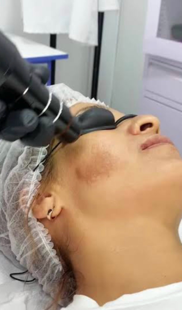 Laser Facial at Integral Body Beauty in Chicago, IL