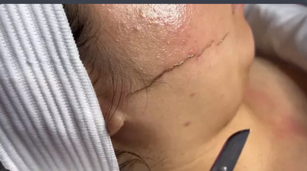 Dermaplane Facial