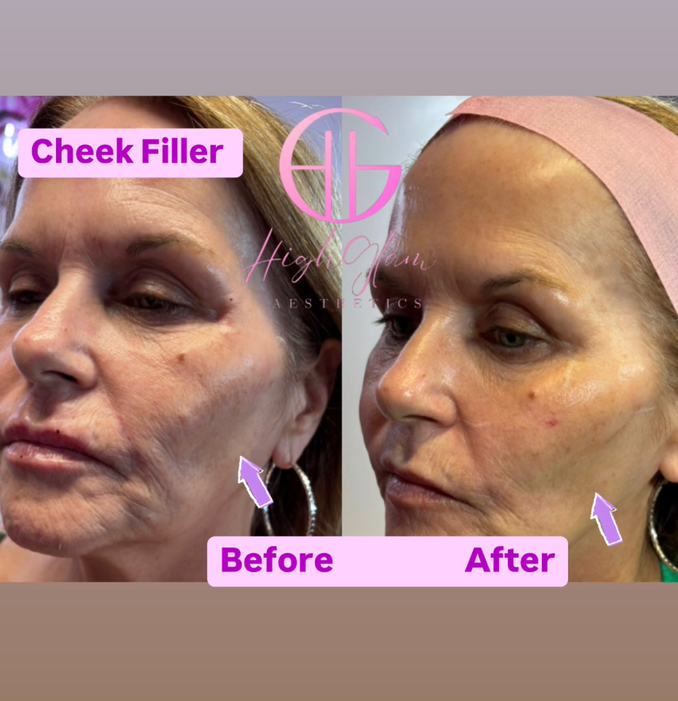 Cheekbone Augmentation