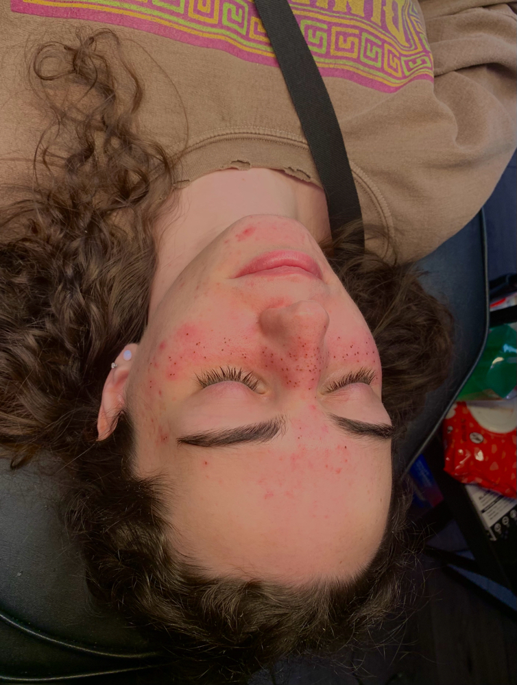 Freckle Touchup