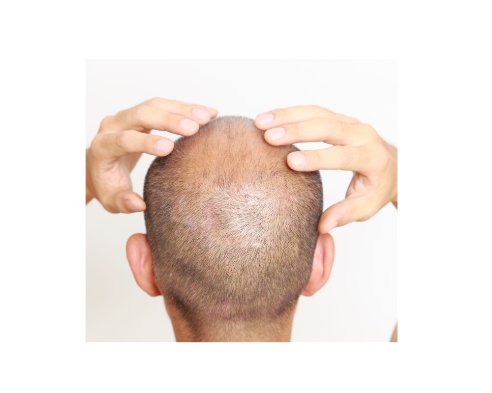 SCALP TOUCH UP