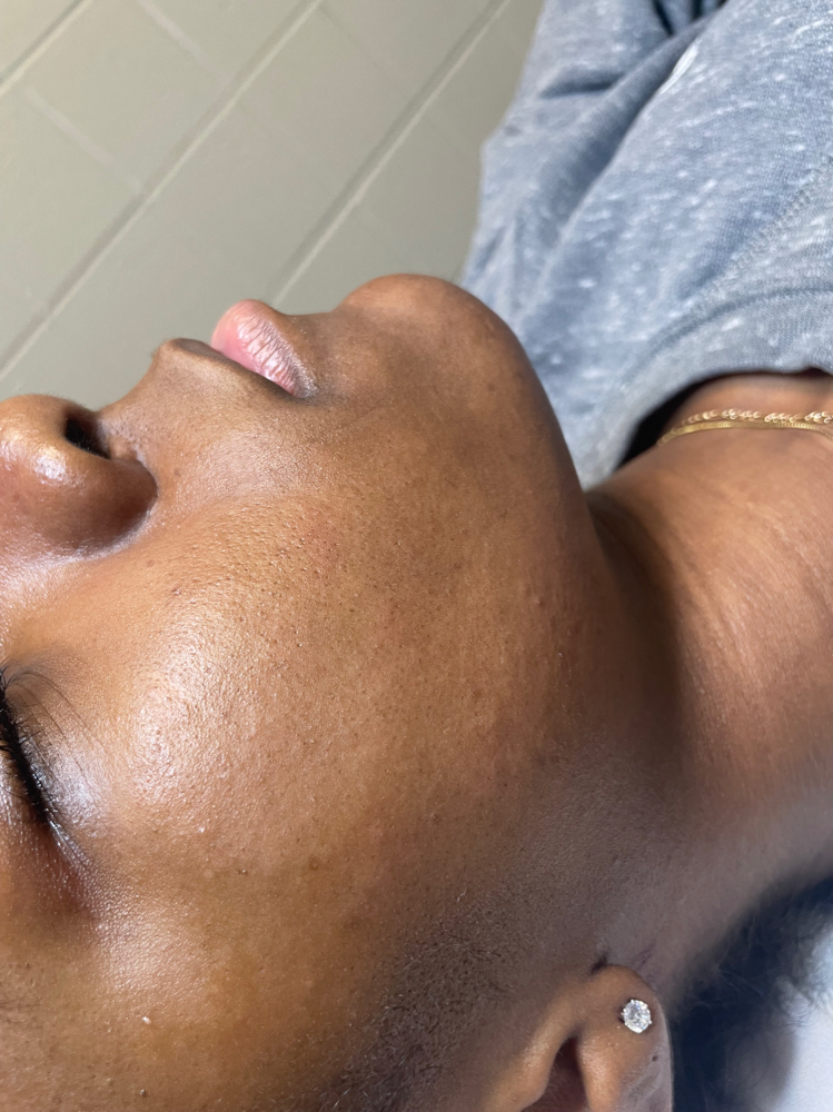 Dermaplane Facial
