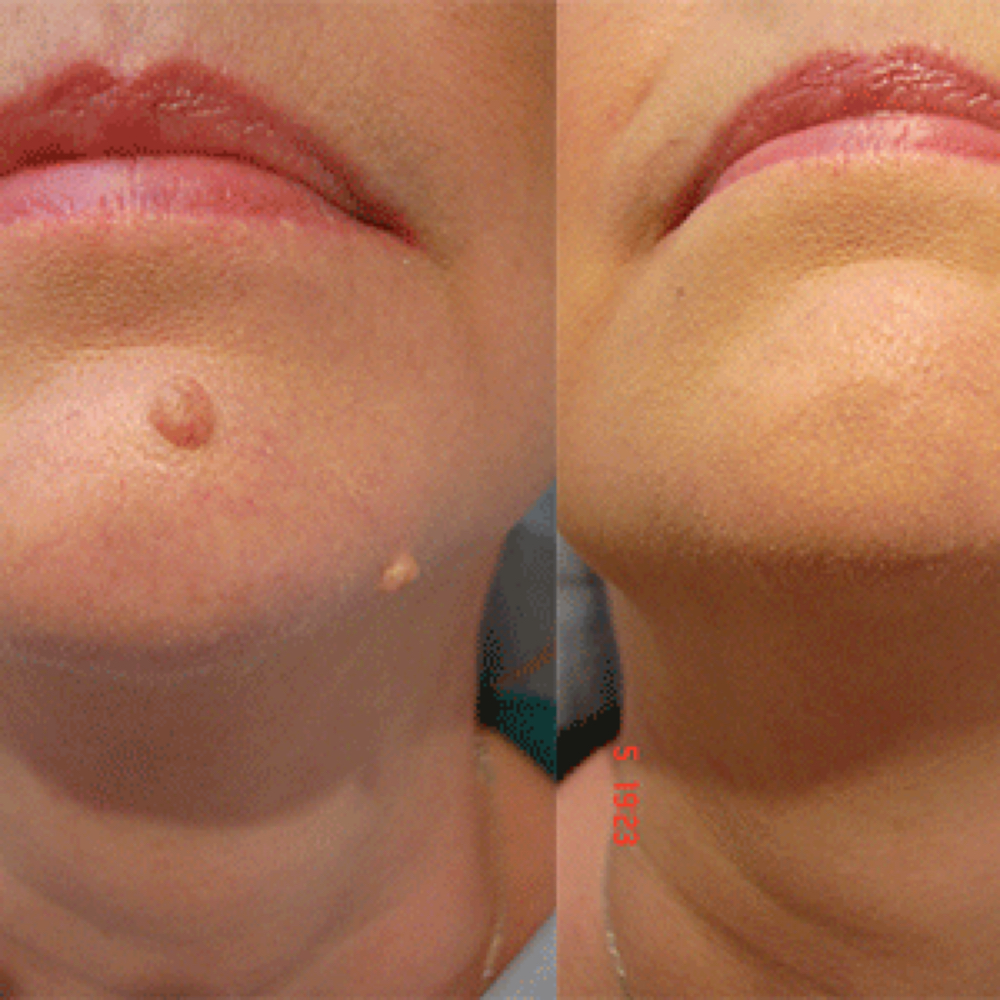 Skin Tag Removal/ Evaluation at Zen Beauty in McAllen, TX