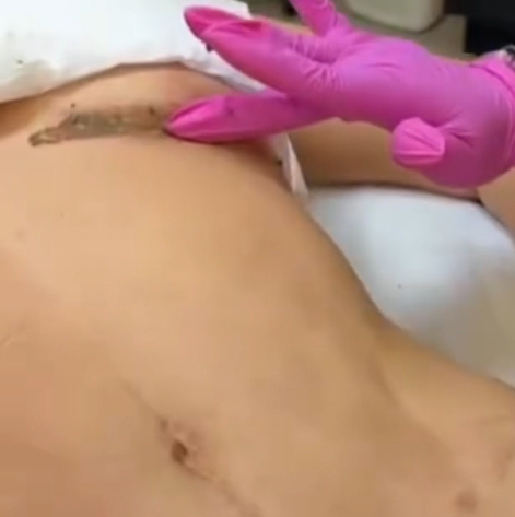 Scar Powder (Seaweed Peel)