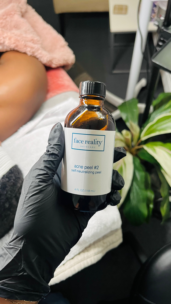 Custom Chemical Peel