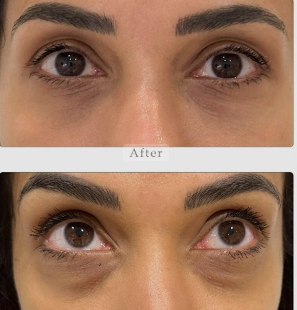 PRP Under Eye Dark Cirles at Beauty Dare Aesthetics PLLC in Laredo, TX