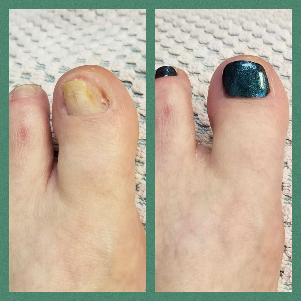 LCN Barefoot | BROKEN TOENAIL REPAIR