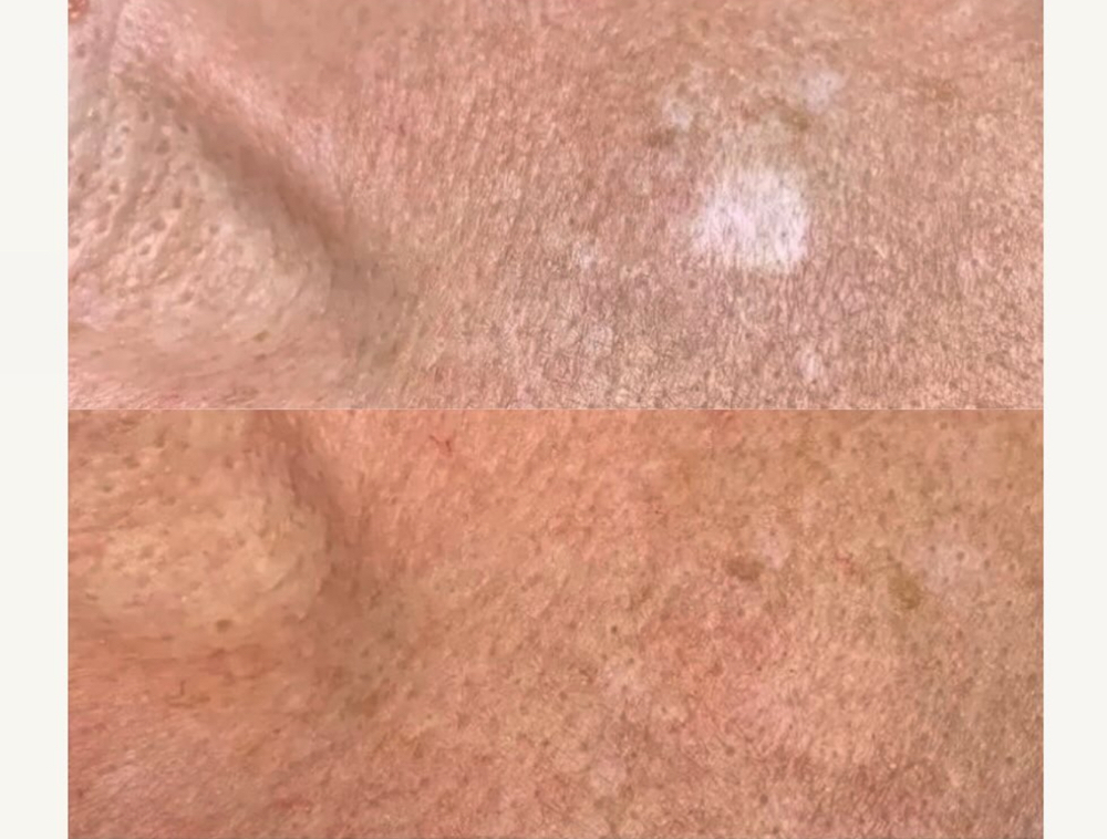 Pigmented Scar Tattoo Therapy