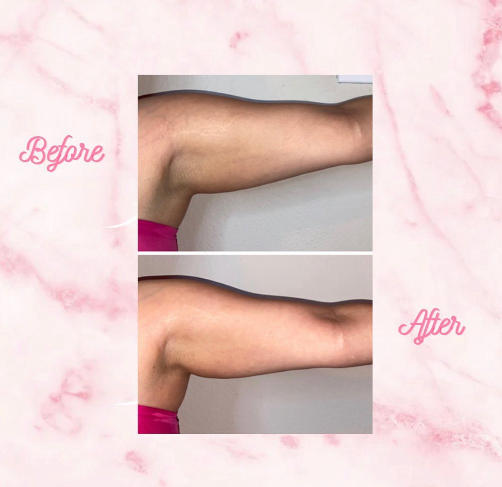 Arms Bodysculpting