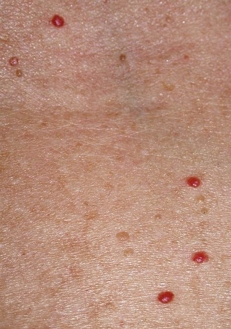 Cherry Angiomas Removal