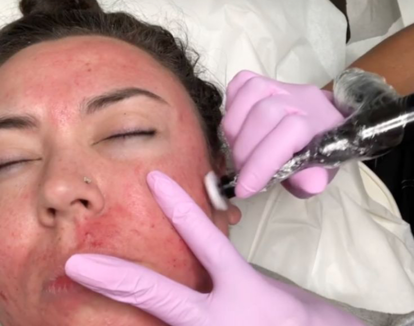 Procell Michrochanneling at BADNBOUGEE NAILS & BEAUTY SALON in Yakima, WA