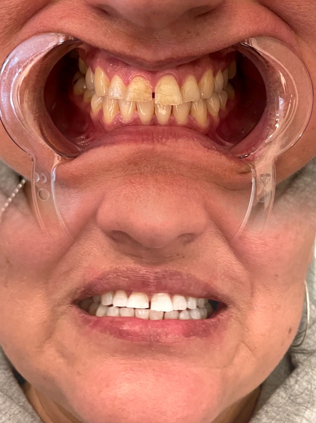 Zoom Whitening
