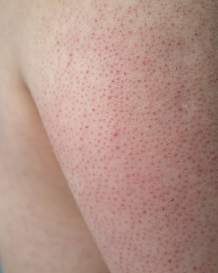 Keratosis Pilaris Treatment
