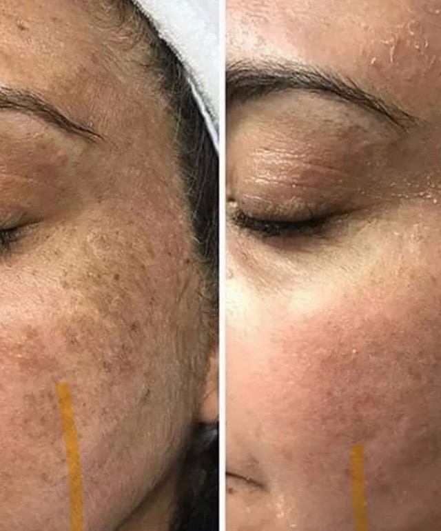 Berry Pigment Control Peel (7% TCA)