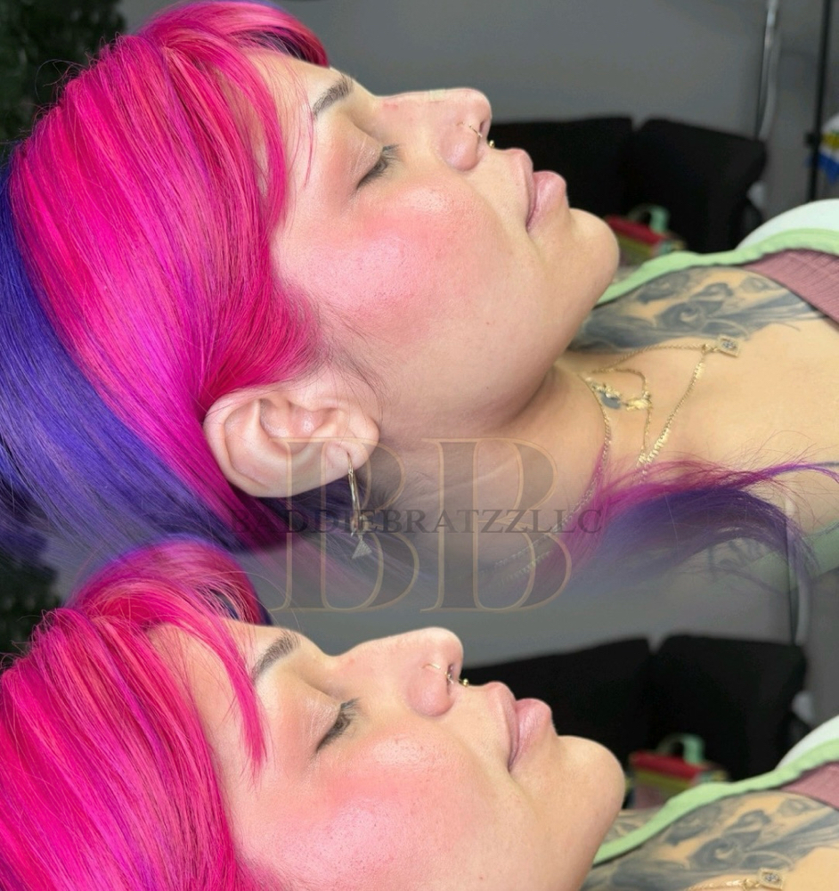 Full Liquid Rhinoplasty W Lift