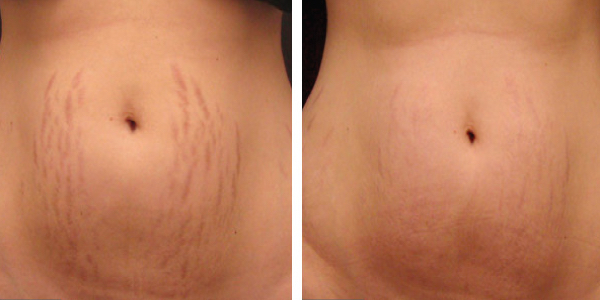 Microneedling - Stomach