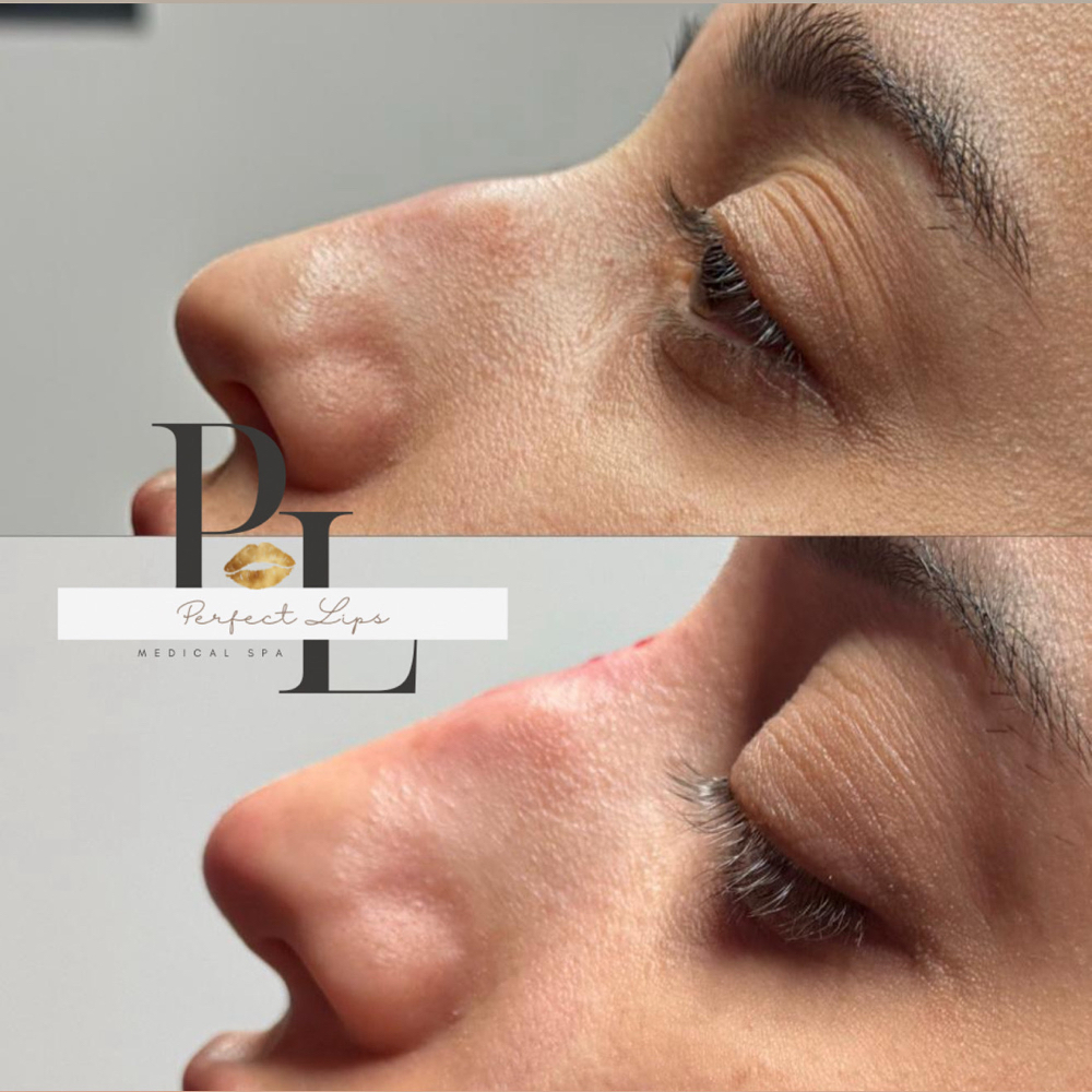 Liquid Rhinoplasty 👃🏼