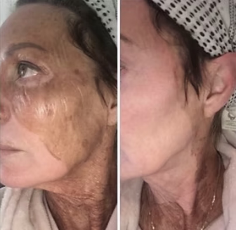 Elaine Brennan Skin Renewal Peel