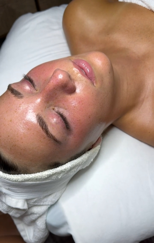 PCA Chemical Peel